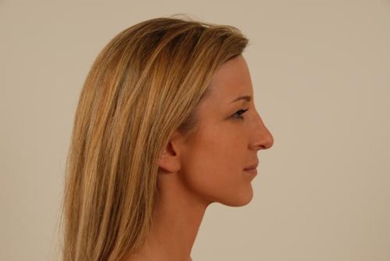 Rhinoplasty Before & After Gallery - Patient 12880257 - Image 10