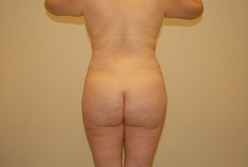 Brazilian Butt Lift Before & After Gallery - Patient 12880262 - Image 2