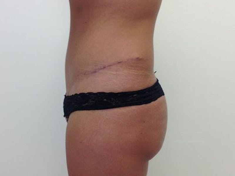 Tummy Tuck Before & After Gallery - Patient 12880261 - Image 6