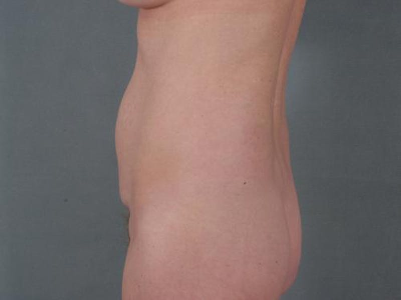 Tummy Tuck Before & After Gallery - Patient 12880266 - Image 1