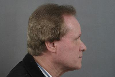 Facelift/Necklift Before & After Gallery - Patient 12880264 - Image 1