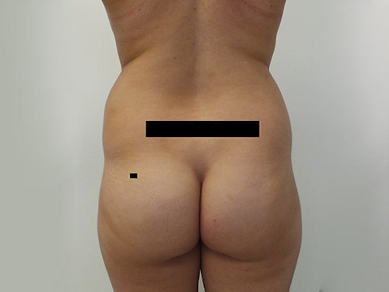 Liposuction Before & After Gallery - Patient 12880265 - Image 1