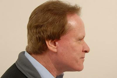 Facelift/Necklift Before & After Gallery - Patient 12880264 - Image 2