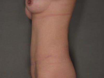 Tummy Tuck Before & After Gallery - Patient 12880266 - Image 2