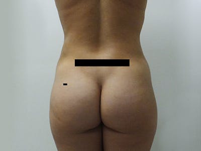 Liposuction Before & After Gallery - Patient 12880265 - Image 2