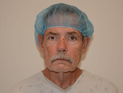 Facelift/Necklift Before & After Gallery - Patient 12880275 - Image 1