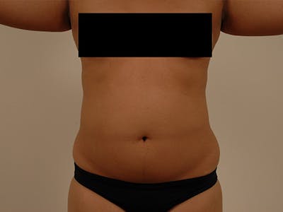 Liposuction Before & After Gallery - Patient 12880272 - Image 1