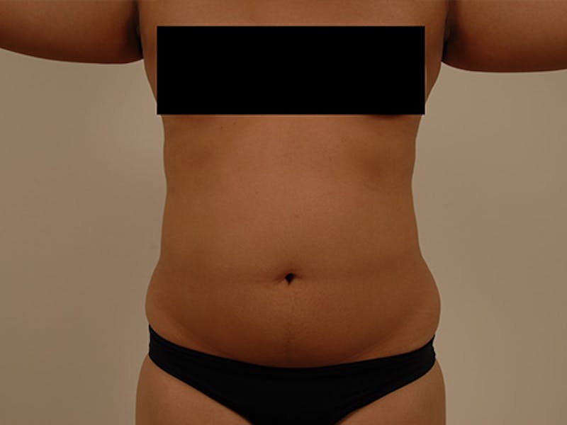 Liposuction Before & After Gallery - Patient 12880272 - Image 1