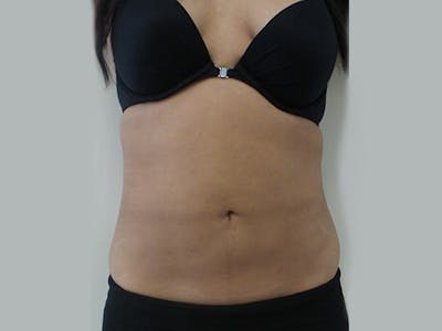 Liposuction Before & After Gallery - Patient 12880272 - Image 2