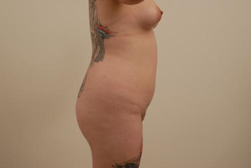 Brazilian Butt Lift Before & After Gallery - Patient 12880277 - Image 5