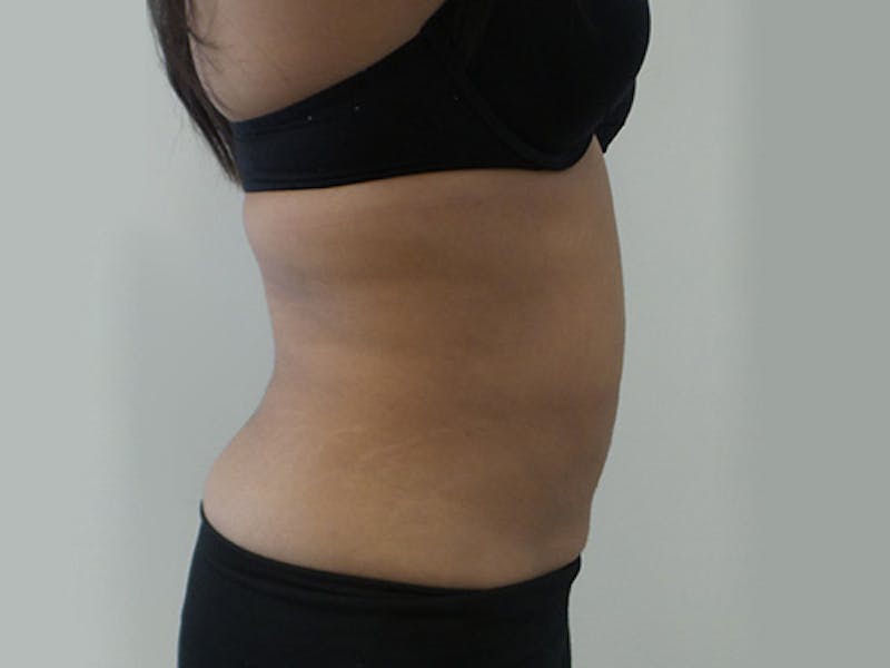 Liposuction Before & After Gallery - Patient 12880272 - Image 4