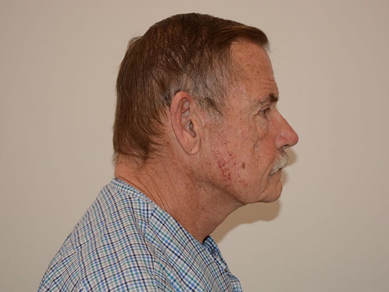 Facelift/Necklift Before & After Gallery - Patient 12880275 - Image 6