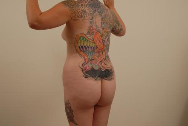 Brazilian Butt Lift Before & After Gallery - Patient 12880277 - Image 9