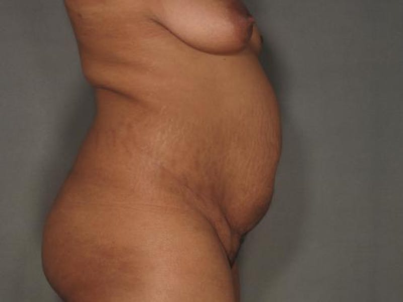 Tummy Tuck Before & After Gallery - Patient 12880279 - Image 5