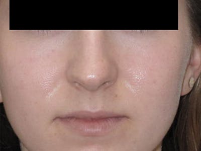 Rhinoplasty Before & After Gallery - Patient 12880284 - Image 1