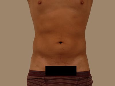 Liposuction Before & After Gallery - Patient 12880289 - Image 1