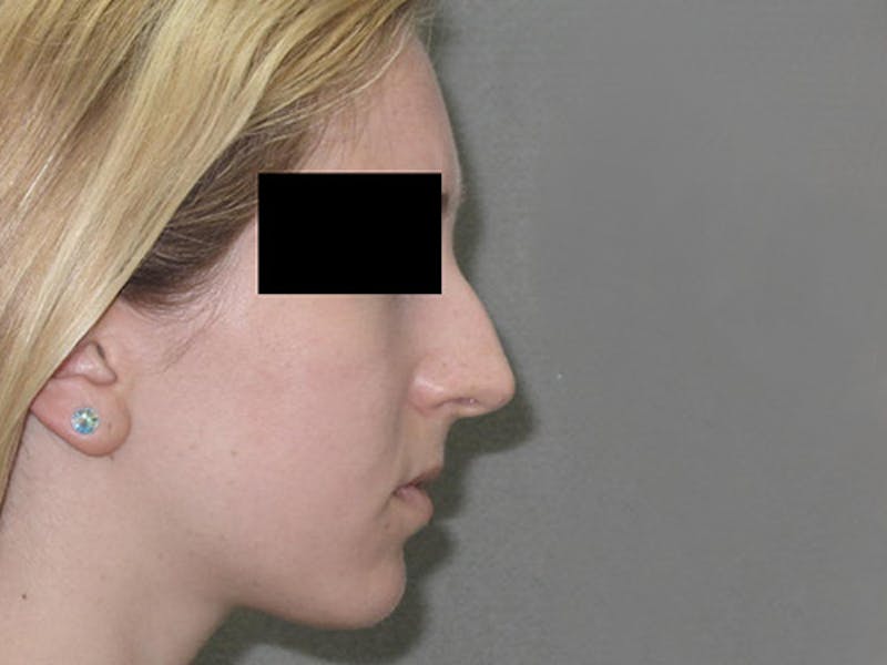 Rhinoplasty Before & After Gallery - Patient 12880284 - Image 5