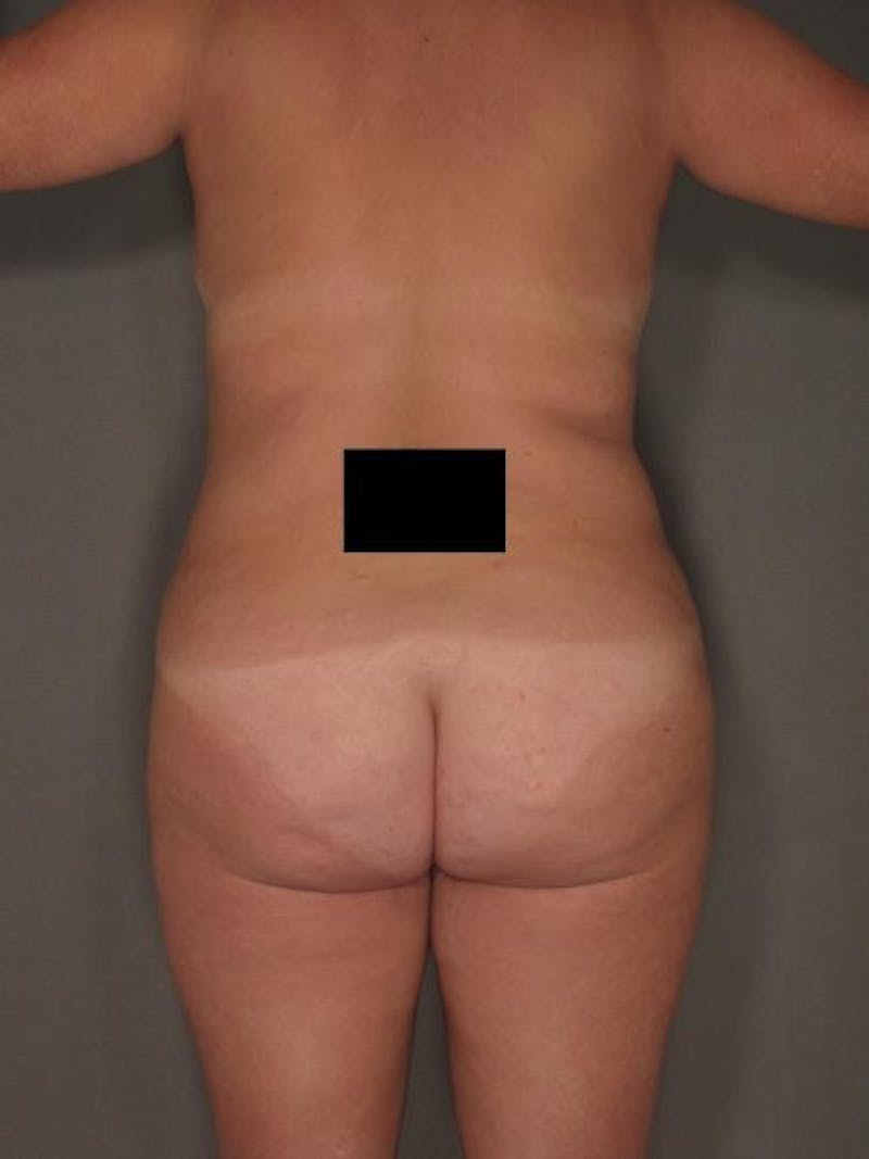 Brazilian Butt Lift Before & After Gallery - Patient 12880290 - Image 5