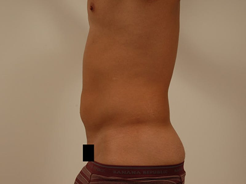Liposuction Before & After Gallery - Patient 12880289 - Image 3