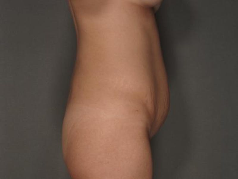 Tummy Tuck Before & After Gallery - Patient 12880287 - Image 5