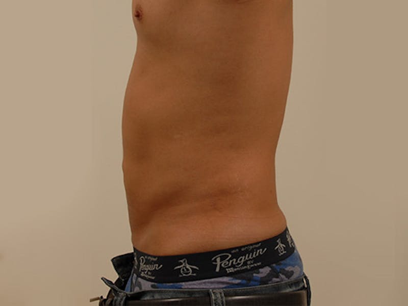 Liposuction Before & After Gallery - Patient 12880289 - Image 4