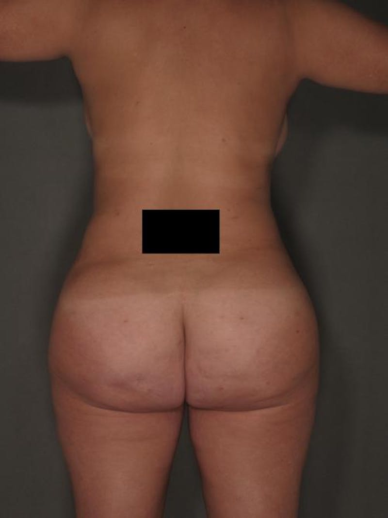 Brazilian Butt Lift Before & After Gallery - Patient 12880290 - Image 6