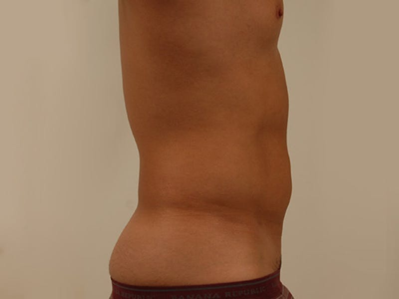 Liposuction Before & After Gallery - Patient 12880289 - Image 5