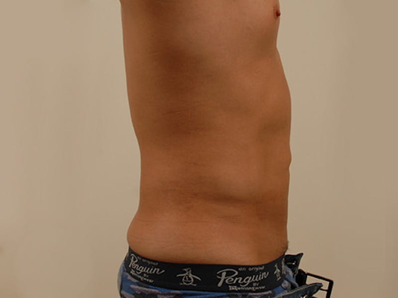 Liposuction Before & After Gallery - Patient 12880289 - Image 6