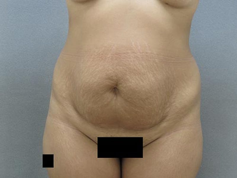 Tummy Tuck Gallery - Patient 12880302 - Image 1
