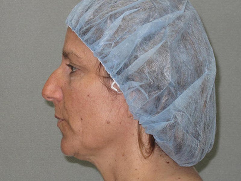 Rhinoplasty Before & After Gallery - Patient 12880291 - Image 3