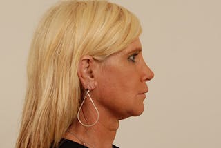 Facial Feminization Before & After Gallery - Patient 12880292 - Image 4