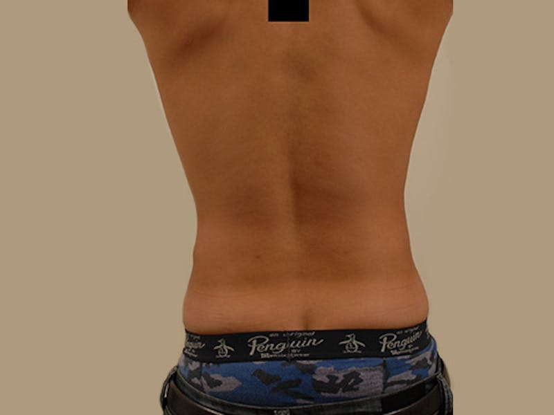 Liposuction Before & After Gallery - Patient 12880289 - Image 8