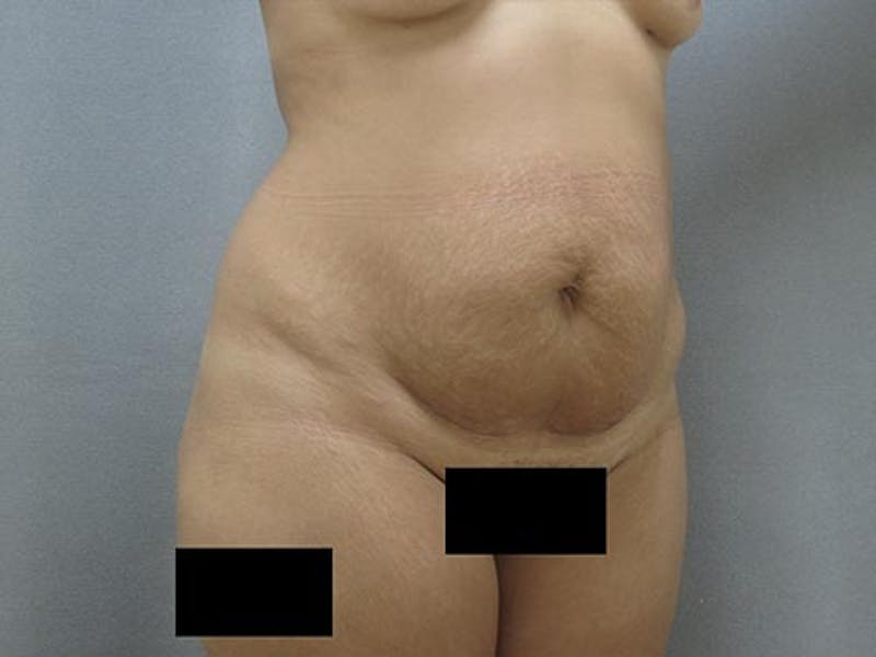 Tummy Tuck Before & After Gallery - Patient 12880302 - Image 3