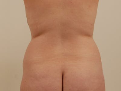 Liposuction Before & After Gallery - Patient 12880293 - Image 1