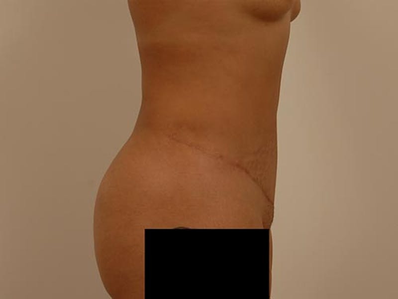 Tummy Tuck Before & After Gallery - Patient 12880302 - Image 6