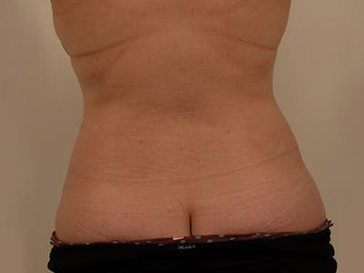 Liposuction Before & After Gallery - Patient 12880293 - Image 2