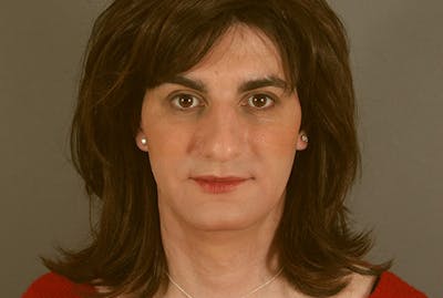 Facial Feminization Before & After Gallery - Patient 12880310 - Image 1