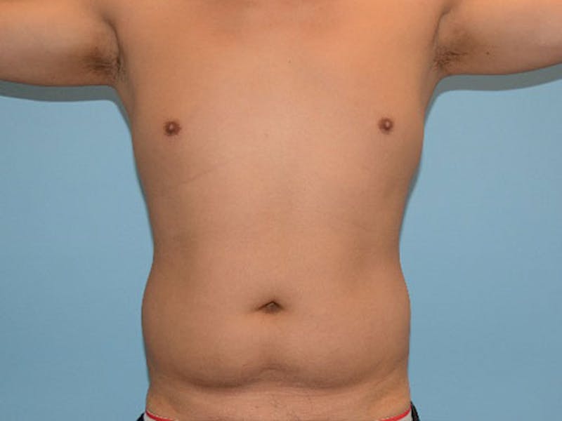 Liposuction Gallery - Patient 12880306 - Image 1