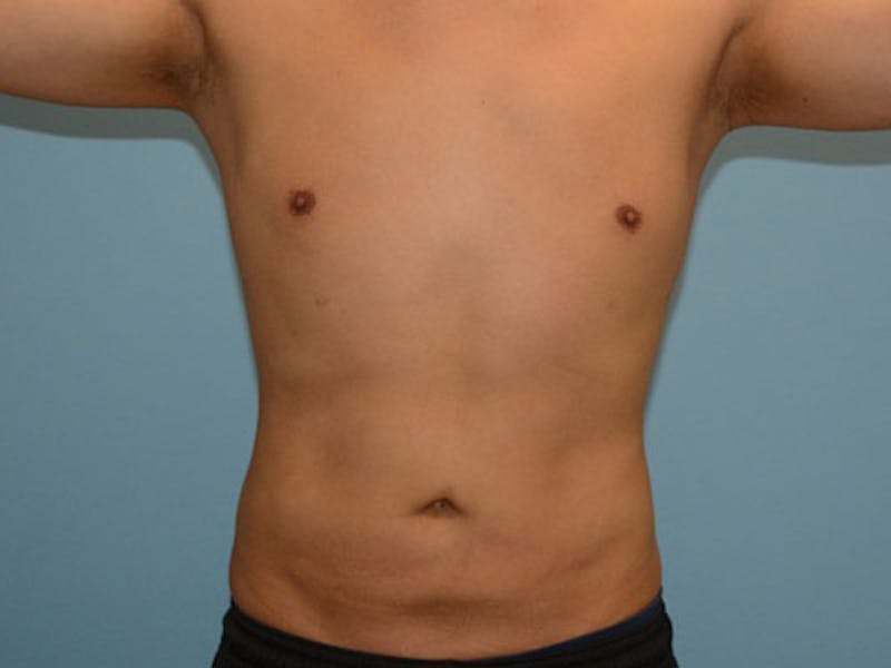 Liposuction Gallery - Patient 12880306 - Image 2