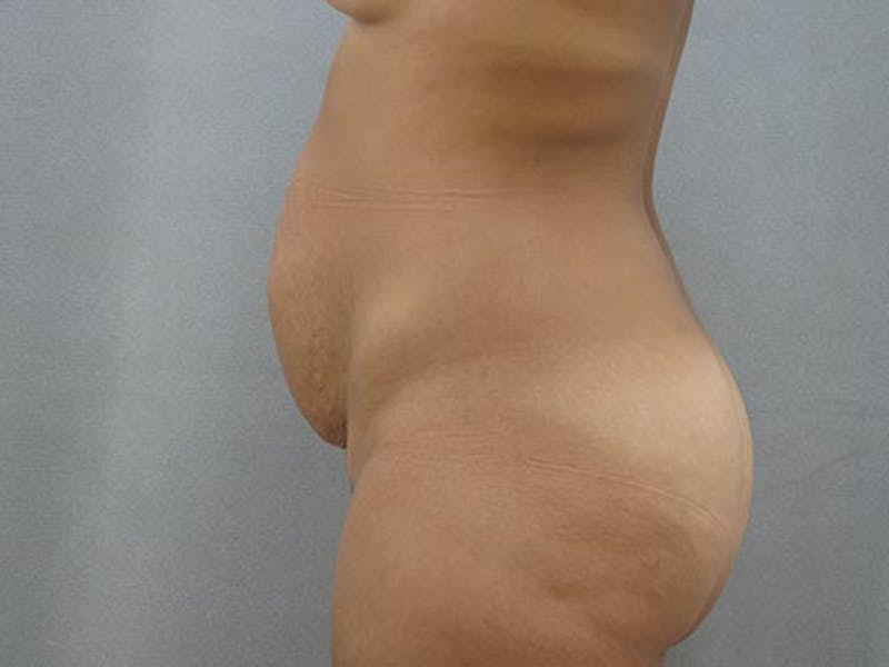 Tummy Tuck Gallery - Patient 12880302 - Image 9