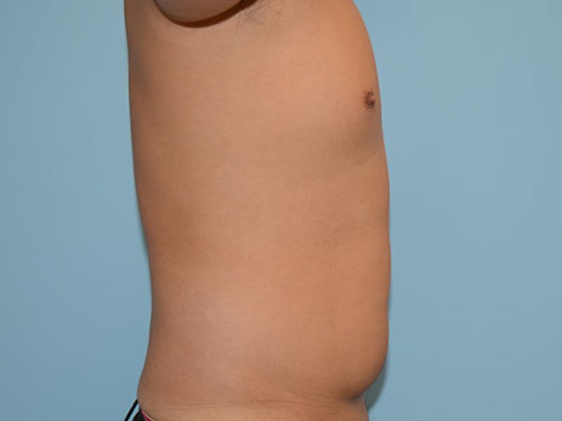 Liposuction Before & After Gallery - Patient 12880306 - Image 3