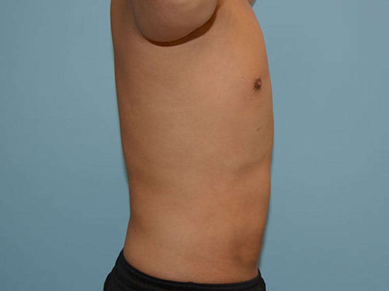 Liposuction Before & After Gallery - Patient 12880306 - Image 4