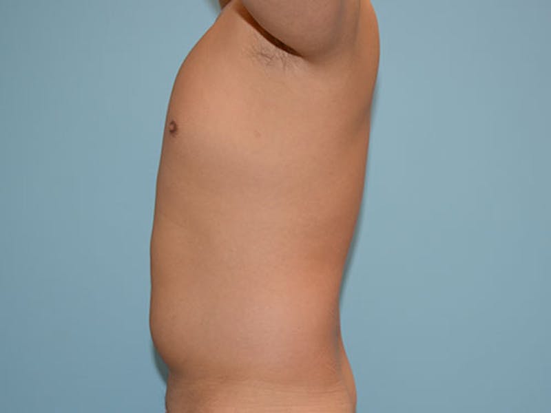 Liposuction Before & After Gallery - Patient 12880306 - Image 5