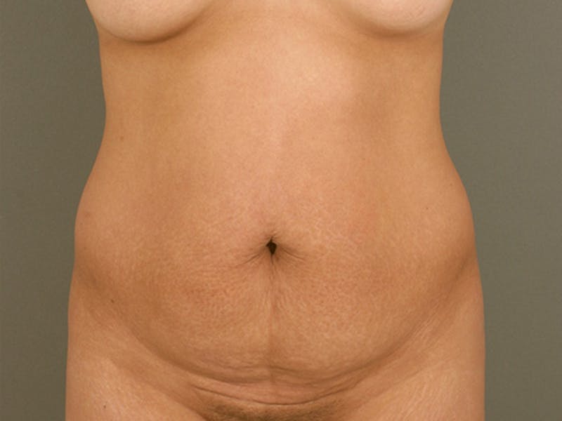 Tummy Tuck Gallery - Patient 12880315 - Image 1
