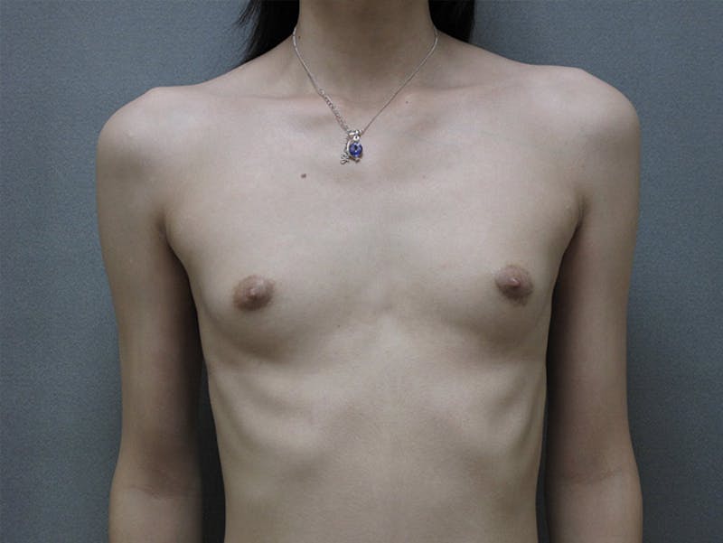 Transgender Breast Augmentation Before & After Gallery - Patient 12880316 - Image 1