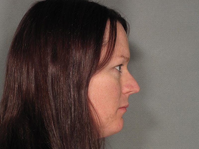 Rhinoplasty Before & After Gallery - Patient 12880309 - Image 5