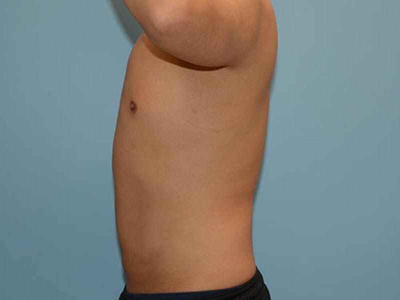Liposuction Before & After Gallery - Patient 12880306 - Image 6