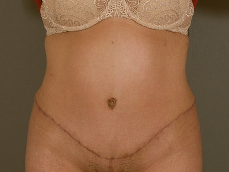 Tummy Tuck Before & After Gallery - Patient 12880315 - Image 2
