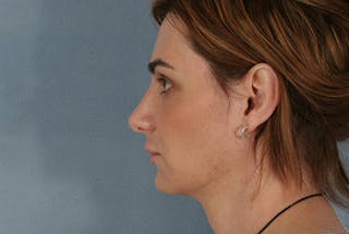 Facial Feminization Before & After Gallery - Patient 12880310 - Image 6
