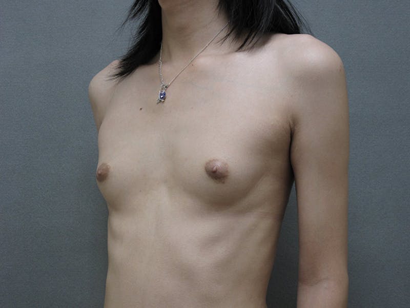 Transgender Breast Augmentation Before & After Gallery - Patient 12880316 - Image 3